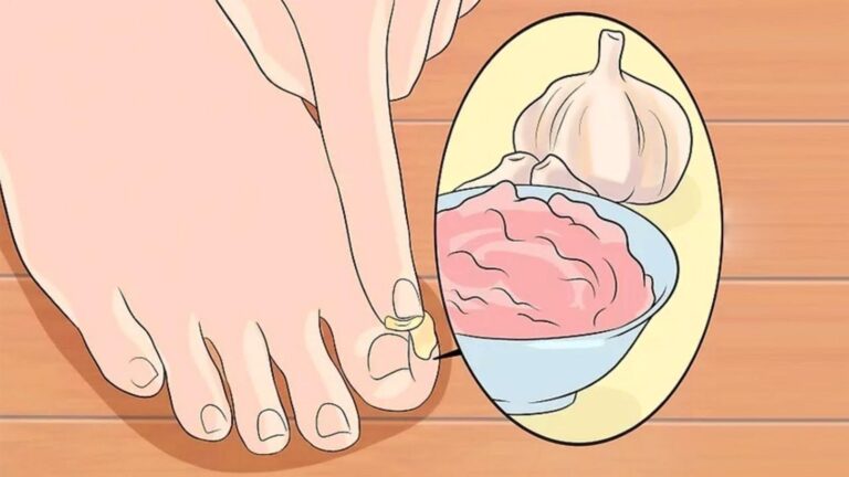 Cette astuce surprenante avec de l’ail transforme vos pieds en un rien de temps…