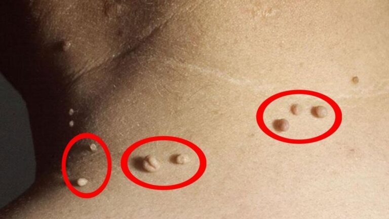 Cette astuce simple va vous débarrasser des boutons de peau…